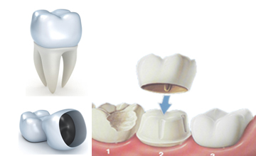 Ennis Smiles crown cap service