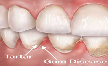 Ennis Smiles Periodontal (Gum) Disease service