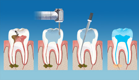 Ennis Smiles Endodontics Therapy service